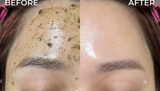 AQUAPEELING + NẶN